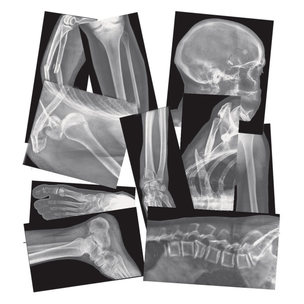 Broken Bones X-Rays